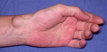 What are some causes of a lump in your wrist below your thumb?