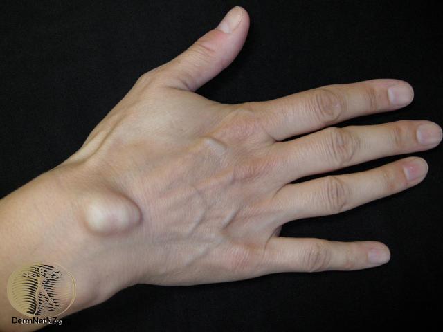 Ganglion Cyst (Wrist, Knee, Foot, Ankle) Pictures, Surgery, Removal