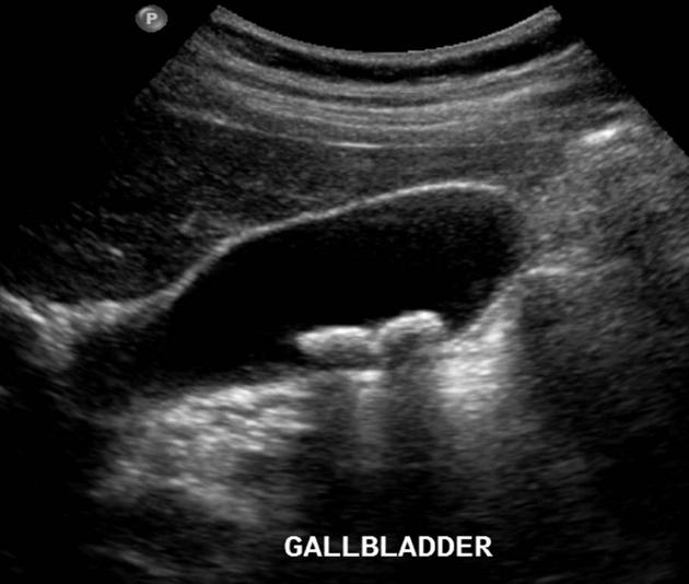 An ultrasound image of the gallbladder with gallstones