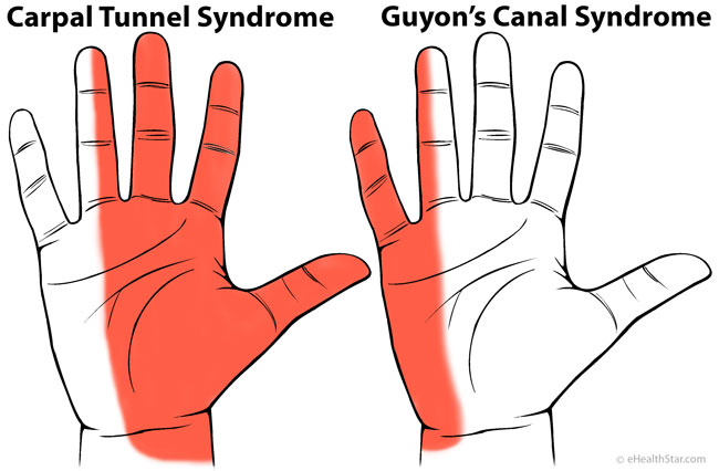 What are some causes of numbness in your left arm?