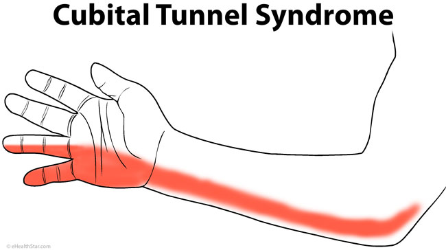 What are some causes of numbness in your left arm?