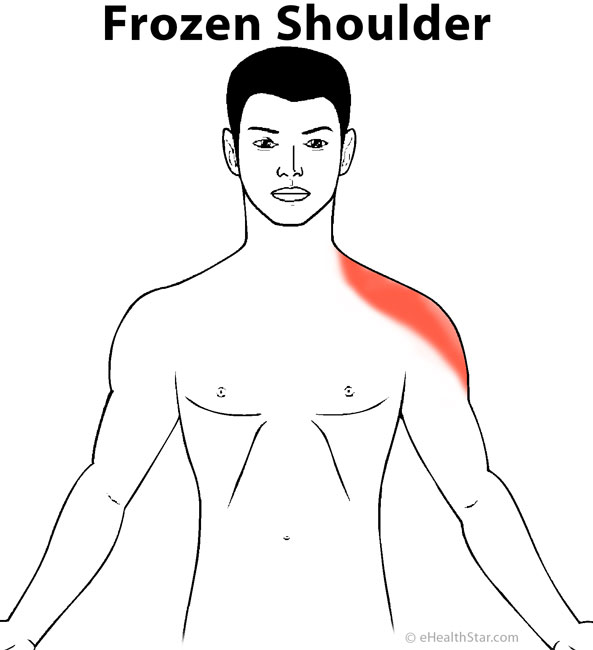 Inflammation Of Shoulder Moving To Leg 30