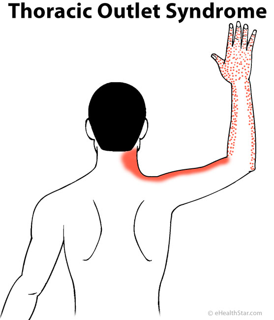 Arm Pain Left Right Both Sharp Dull Muscle Nerve In Women