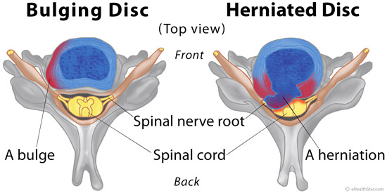 What is the treatment for a diffuse disc bulge?