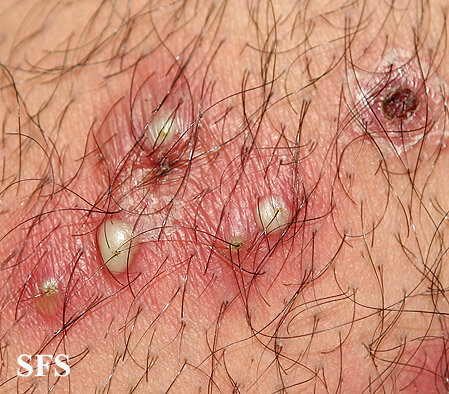 Staph Infection Symptoms, Causes, Pictures & Treatment