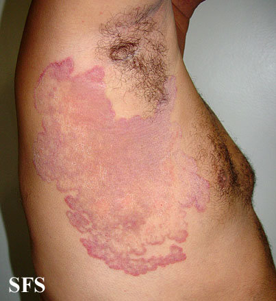 Red Brown Spots On Legs And Armpits 116