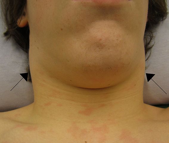 Swollen Lymph Nodes Near Ear Under Jawchin In Neck Armpits Groin