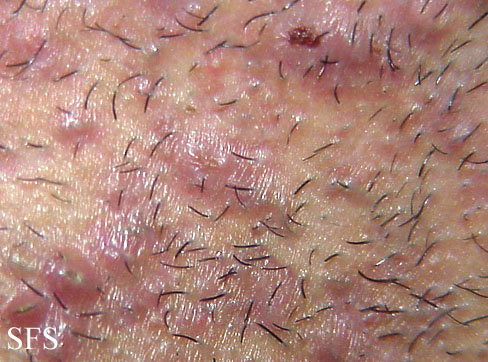 Folliculitis caused by steroid cream