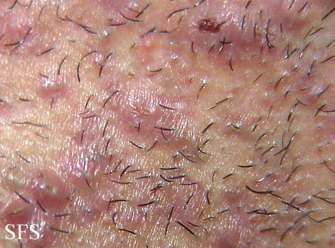 Steroid cream dermatitis