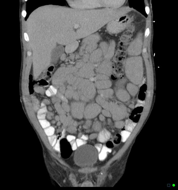 Swollen Lymph Nodes Near Ear, Under Jaw/Chin, in Neck, Armpits, Groin