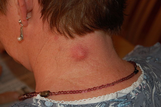 Lumps and Bumps at Back or Side of Neck: Small, Large ...