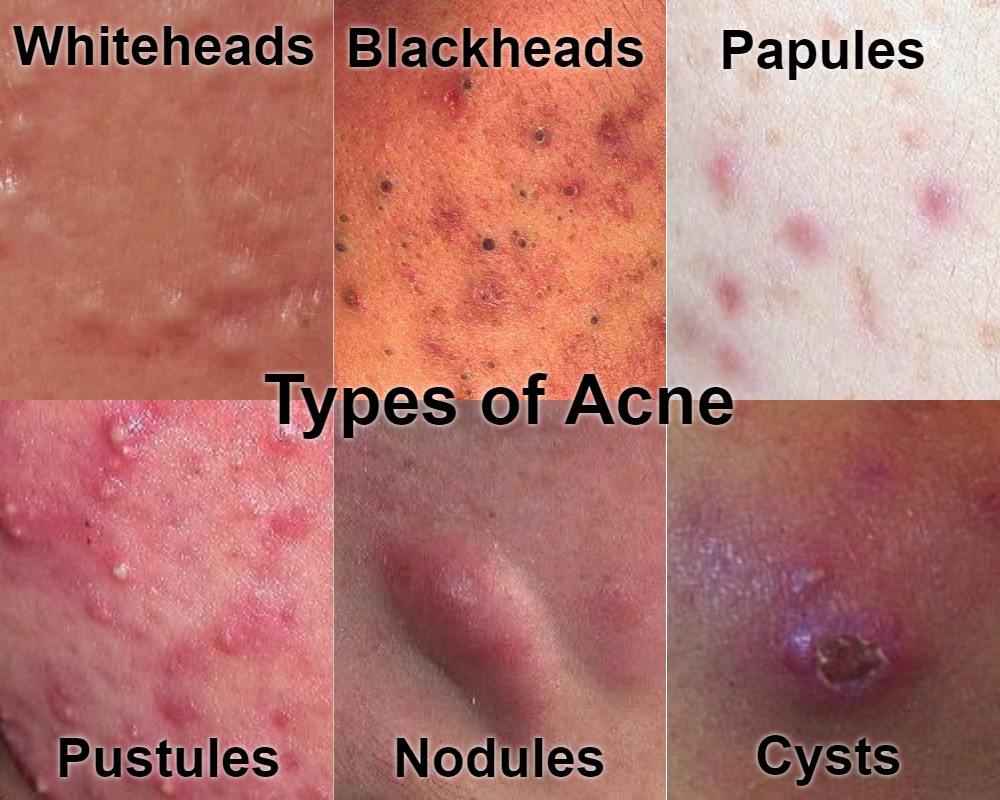 Types of Acne With Pictures: Mild, Moderate, Severe