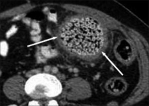 Seed bezoar in the colon, CT image