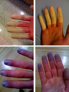 Raynaud's Syndrome Photo