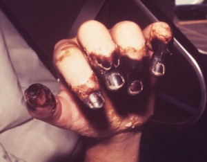 Black fingers, gangrene, plague photo