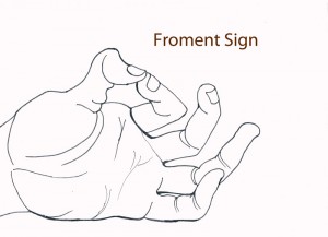 Froment's Sign