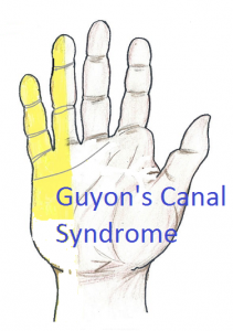 Guyon's canal syndrome picture