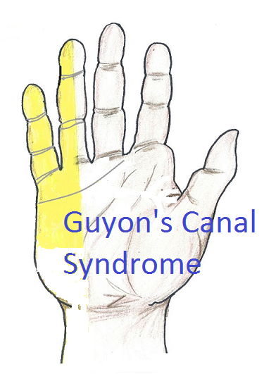 Guyon's canal (tunnel) syndrome