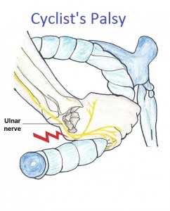 Guyon's canal syndrome picture