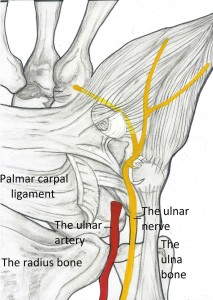 Guyon's canal syndrome release surgery picture