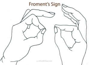 Picture of Froment's Sign