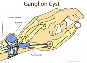 Ganglion cyst on wrist Image