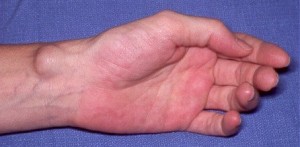 Ganglion Cyst on Wrist Picture