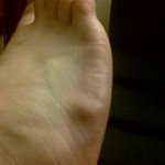 Ganglion Cyst on Foot Picture