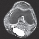 ganglion cyst behind the knee (baker cyst) mri