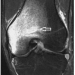 geographic bone bruise knee MRI