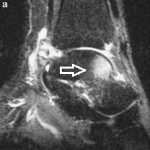 bone bruise ankle talus image MRI