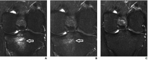 bone bruise knee tibia MRI