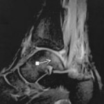 bone bruise ankle talus MRI