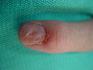 digital mucous cyst nail