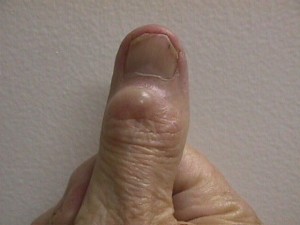 mucous ganglion cyst thumb