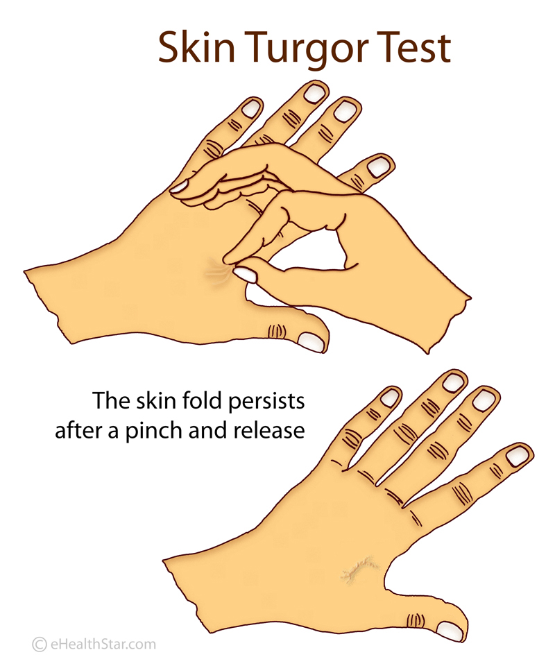 How To Chart Skin Turgor