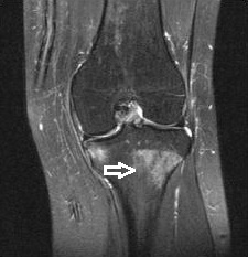 bone bruise knee MRI