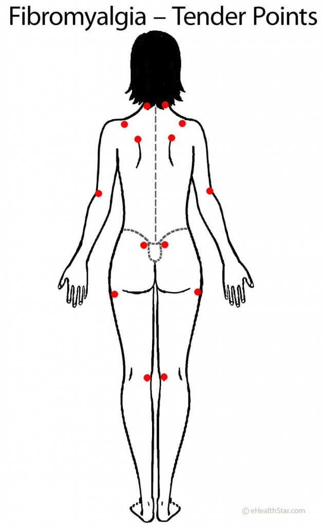 Fibromyalgia Tender Points