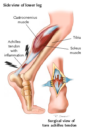 Achilles tendon tear
