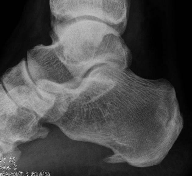 Calcaneal spur x-ray image