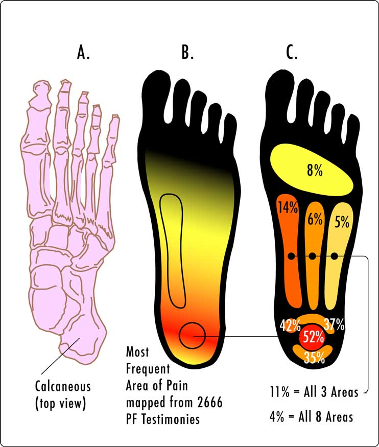 Heel Pain (Bottom, Back, Side) from Walking, Running Causes, Treatment