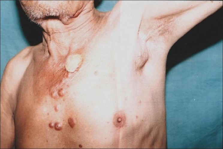 Armpit lump - swollen lymph node due to leukemia