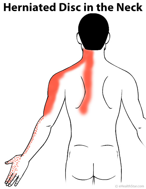 Arm Pain: Left, Right, Both, Sharp, Dull, Muscle, Nerve ...