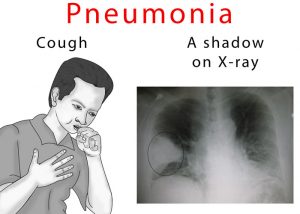 pneumonia cough shadows ehealthstar xray sputum