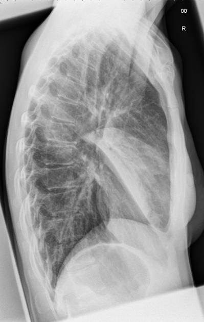 Lobar pneumonia x-ray