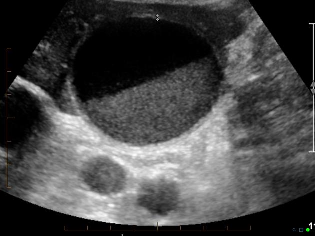 Gallbladder or biliary sludge