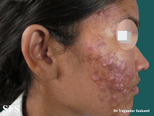 Steroid acne on the face