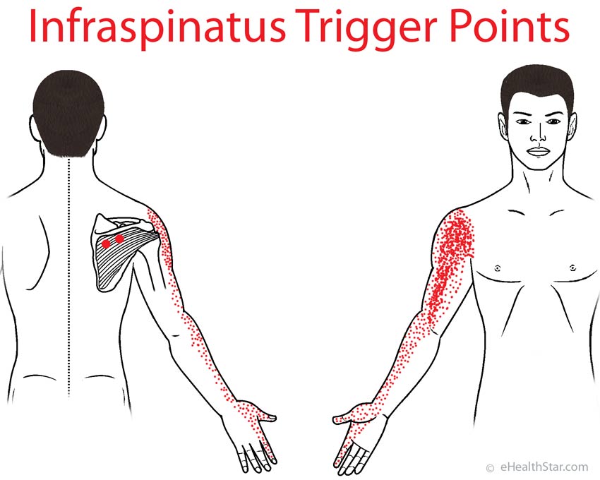 Infraspinatus trigger points