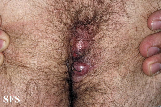 Pilonidal cyst from ingrown hair between buttocks