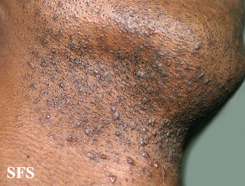 Pseudofolliculitis barbae or razor bumps